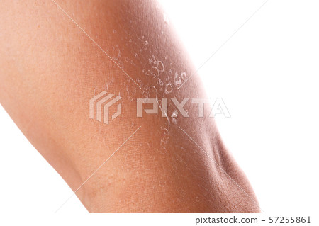 Skin peeling after sunburn 57255861