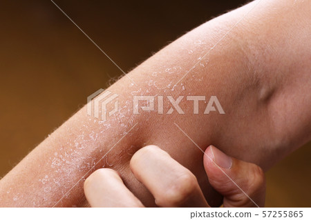 Skin peeling after sunburn Skin peeling after sunburn 57255865