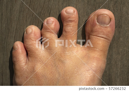 Senior women's crooked toes, Dry skin on wood background, Close up & Macro shot, Body part, Healthcare concept Senior women's crooked toes, Dry skin on wood background, Close up & Macro shot, Body part, Healthcare concept 57266232