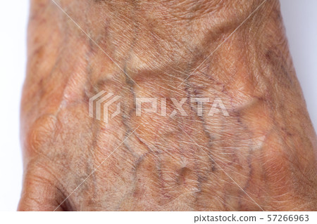 Skin Blood Varicose veins on foot in Senior women, Close up & Macro shot, Selective focus, Body part, Healthcare concept 57266963