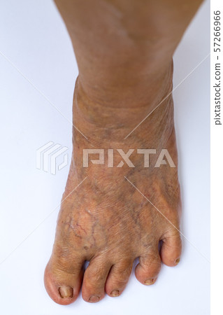 Skin Blood Varicose veins on left foot, Damaged toenail, Crooked toes in Senior women, White background, Close up & Macro shot, Selective focus, Body part, Healthcare concept Skin Blood Varicose veins on left foot, Damaged toenail, Crooked toes in Senior women, White background, Close up & Macro shot, Selective focus, Body part, Healthcare concept 57266966