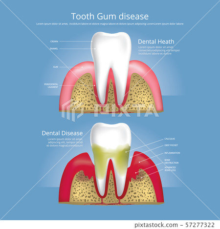 Human teeth Stages of Gum Disease Vector Illustration Human teeth Stages of Gum Disease Vector Illustration 57277322