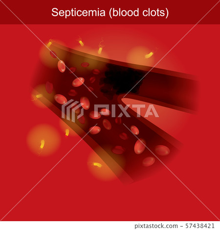 Septicemia infographic 3d Illustration. Septicemia infographic 3d Illustration. 57438421