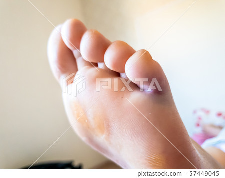 Little toe broken getting coloured blue and purple. Little toe broken getting coloured blue and purple. 57449045