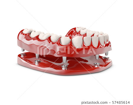 Human teeth and Dental implant. 3d illustration Human teeth and Dental implant. 3d illustration 57485614