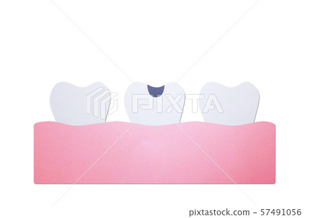decay tooth or dental caries decay tooth or dental caries 57491056