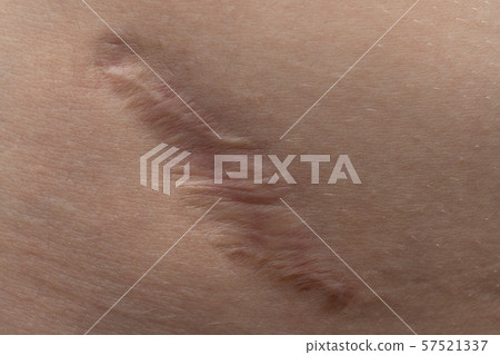Macro photo of the young human's scar texture Macro photo of the young human's scar texture 57521337