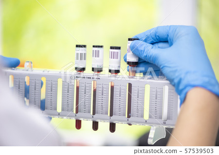 Erythrocyte sedimentation rate test in laboratory Erythrocyte sedimentation rate test in laboratory 57539503