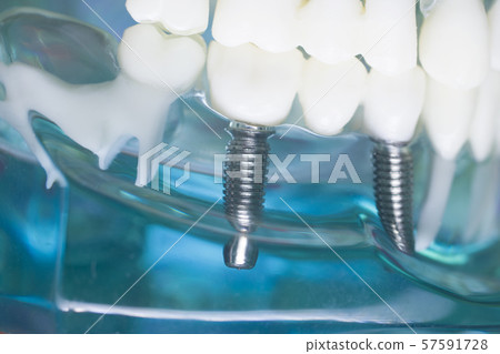 Dentist teeth implant dental model Dentist teeth implant dental model 57591728