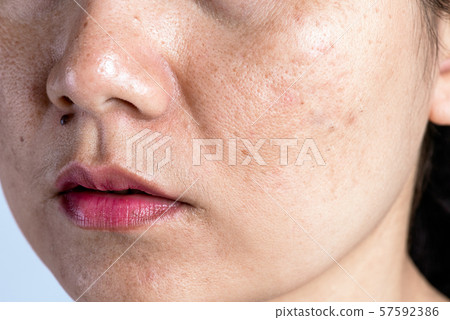 Woman with problematic skin and acne scars. 57592386