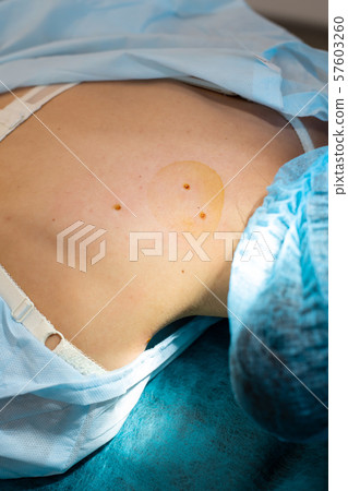 The surgeon does surgery to remove the mole on the 57603260