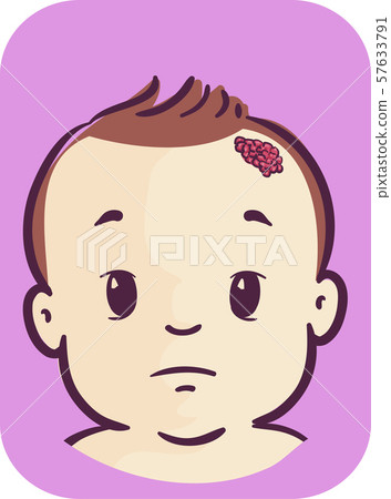 Baby Symptom Strawberry Nevus Illustration 57633791
