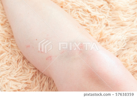 Sport injury and health. Bruised knee. Sport injury and health. Bruised knee. 57638359