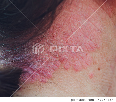 Neck and shoulder view with skin allergy. Dark tone with shadow and black background. Focus on neck Neck and shoulder view with skin allergy. Dark tone with shadow and black background. Focus on neck 57732432