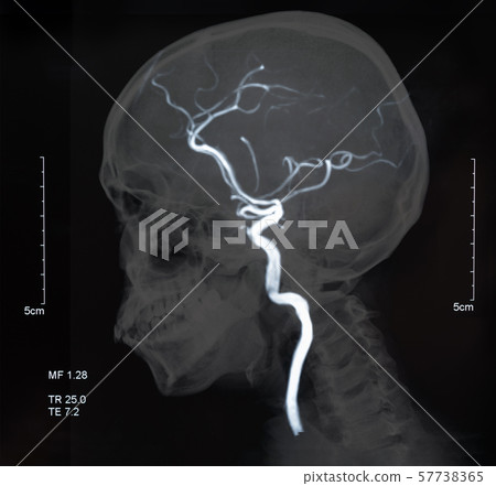 mri blood vessels 57738365