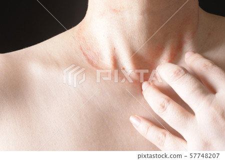 Women with skin disease 57748207