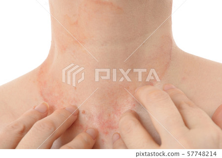 Women with skin disease 57748214