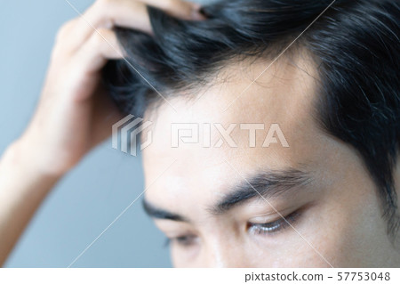 Young man serious hair loss problem for health 57753048