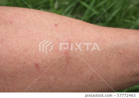 Arms bitten by insects in the field Arms bitten by insects in the field 57772463