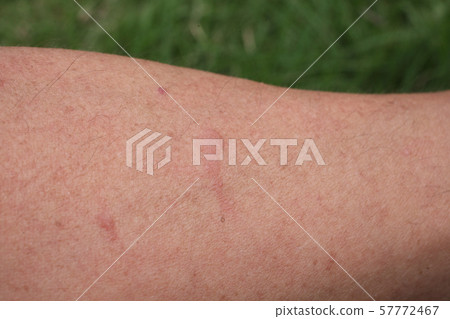 Arms bitten by insects in the field Arms bitten by insects in the field 57772467