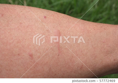 Arms bitten by insects in the field 57772469