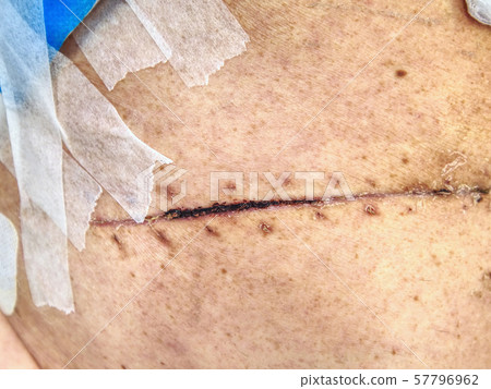Bandage of fresh scar on the abdomen and side of Bandage of fresh scar on the abdomen and side of 57796962