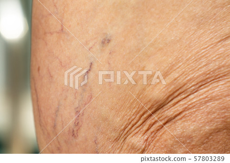 Varicose veins on a leg in Senior women, Blurred and bokeh background, Close up & Macro shot, Selective focus, Asian body skin part, Healthcare concept 57803289