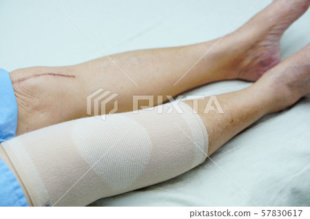 Asian senior or elderly old lady woman patient show her scars surgical total knee joint replacement Suture wound surgery arthroplasty on bed in nursing hospital ward Asian senior or elderly old lady woman patient show her scars surgical total knee joint replacement Suture wound surgery arthroplasty on bed in nursing hospital ward 57830617