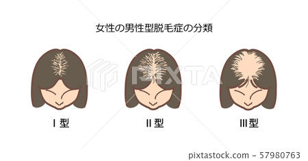 Classification of female androgenetic alopecia 2 with title Classification of female androgenetic alopecia 2 with title 57980763