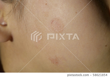 Skin disease (cold sores, ringworm on the body) Skin disease (cold sores, ringworm on the body) 58021854