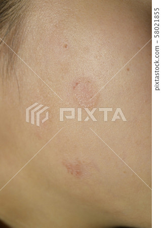 Skin disease (cold sores, ringworm on the body) Skin disease (cold sores, ringworm on the body) 58021855