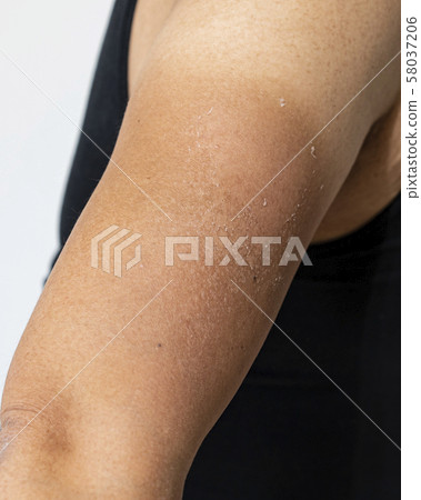 The arm of a woman whose skin has peeled after sunburn The arm of a woman whose skin has peeled after sunburn 58037206