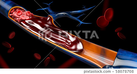 3d Illustration of Deep Vein Thrombosis or Blood 58078708