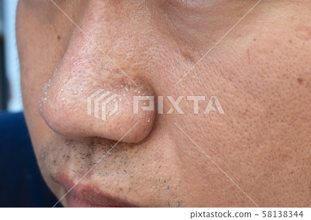 acne vulgaris on nose of asian man 58138344