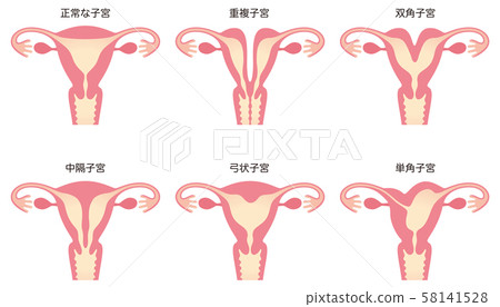 子宮畸形 子宮畸形 58141528