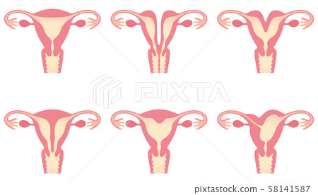 Uterine malformation 58141587
