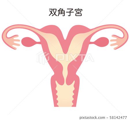 子宮畸形 子宮畸形 58142477