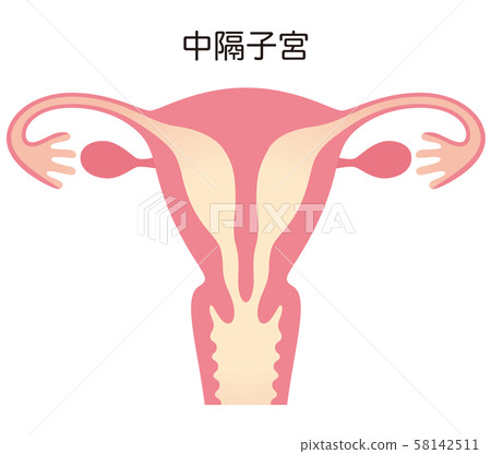 子宮畸形子宮中隔 子宮畸形子宮中隔 58142511