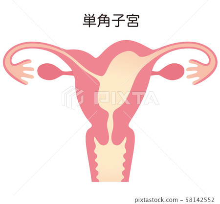子宮畸形 子宮畸形 58142552