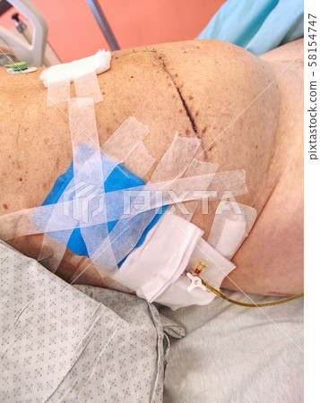 Patient demonstrates fresh scar and ileostomy on 58154747