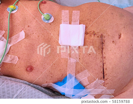 Patient demonstrates fresh scar and ileostomy on 58159788