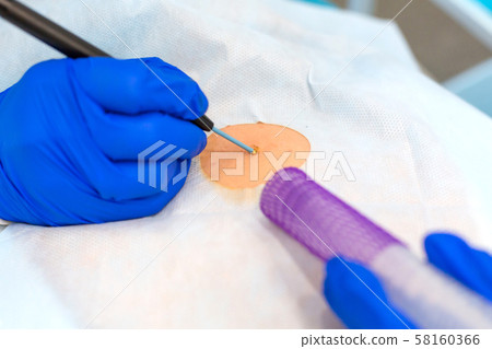 Close-up surgeon burns a mole on the back of the 58160366