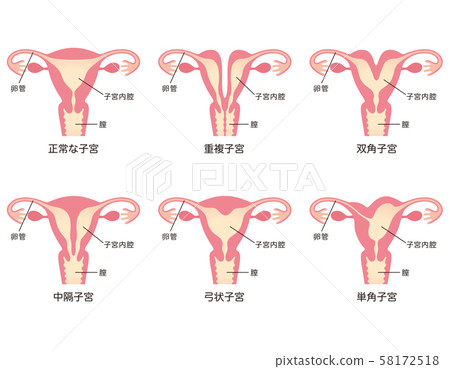 子宮畸形 子宮畸形 58172518