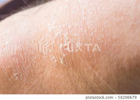 Peeling on the knee 58206679
