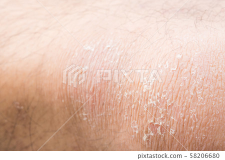 Peeling on the knee 58206680