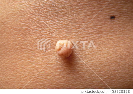 Skin Tag, Close Up Acrochondon on Female Skin. 58220338