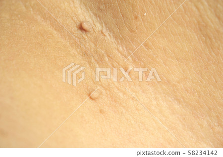 Pedunculated Mass skin tag or acrochondon or soft 58234142