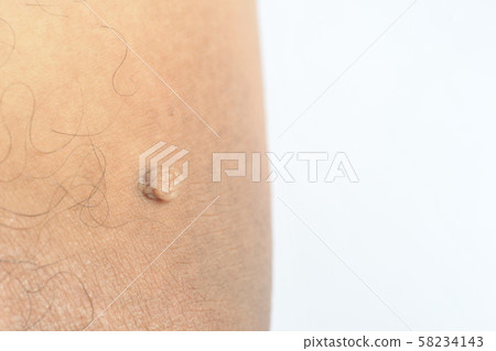 Pedunculated Mass skin tag or acrochondon or soft Pedunculated Mass skin tag or acrochondon or soft 58234143