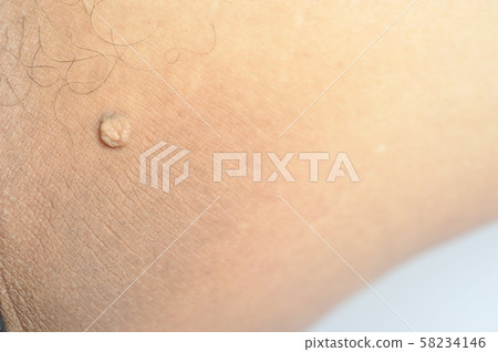 Pedunculated Mass skin tag or acrochondon or soft 58234146