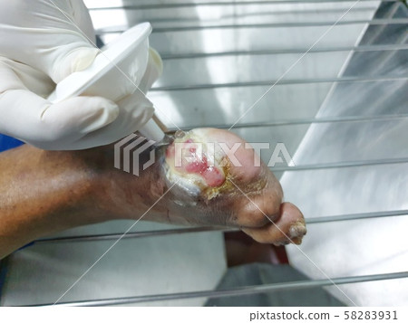 Patient healing wounds diabetes mellitus 58283931